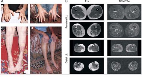 Pin On Myopathies