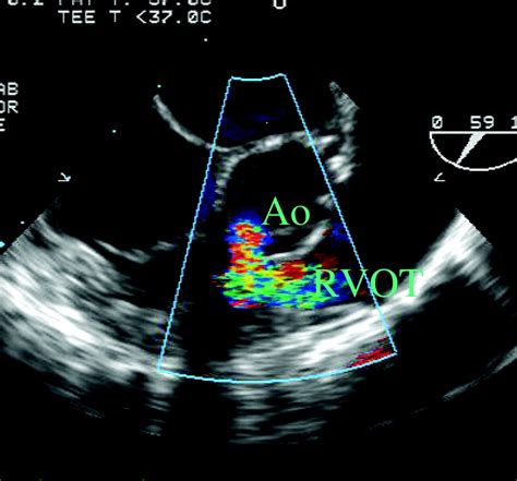 Ventricular Septal Defects Circulation