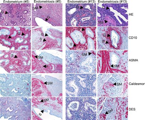 Immunohistochemistry Comparing Peritoneal Endometriosis Lesions With