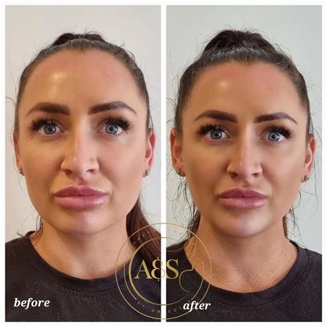 Dermal Fillers Bournemouth Hampshire Cheek Lip Fillers Dorset