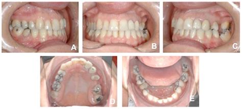 Fig Initial Intra Oral Photos A Right Side B Front View C Left