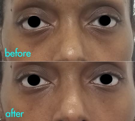 Under Eye Filler Dr Brett Kotlus