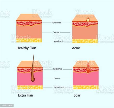 Demodicosis Face Mites Demodex Folliculorum Stock Illustration Download