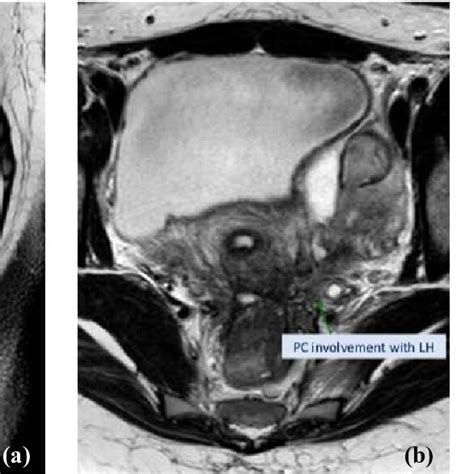 A Sagittal View Of Mri Demonstrating Deep Infiltrating Endometriosis Download Scientific