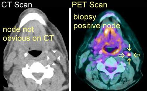 Ct Vs Pet Scan For Cancer Cancerwalls