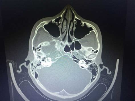 Case Study Headache Retro Orbital Pain And Diplopia Clinical Pain