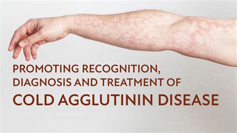 Promoting Recognition Diagnosis And Treatment Of CAD