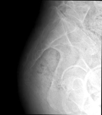 Coccyx fracture - serremessage