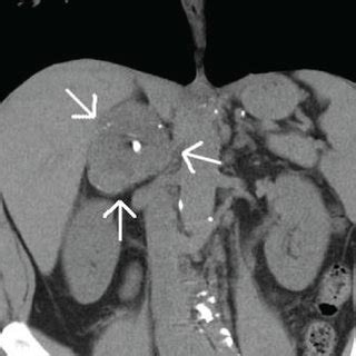 Adrenal Protocol CT Abdomen Coronal Demonstrates A 5 6 7 7 Cm