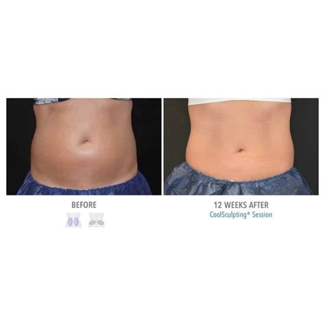 Best CoolSculpting Results in Alpharetta, GA at Sculpted Contours