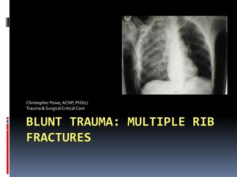 Ppt Blunt Trauma Multiple Rib Fractures Powerpoint Presentation Free Download Id 9347667