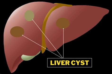 Liver Cyst: What Is It? How To Prevent And Treat - QPIOR