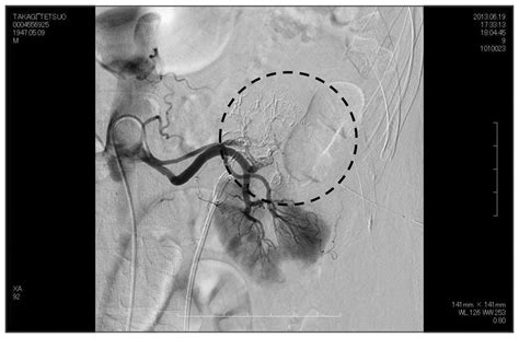 Usefulness Of Selective Renal Artery Embolization For Urinary Fistula