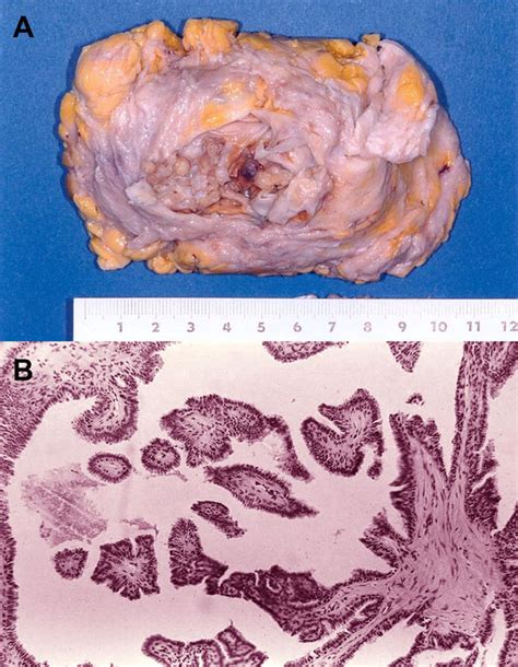 Multifocality Multicentricity And Bilaterality Of Breast Cancer