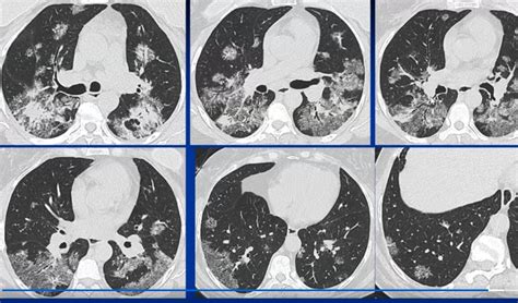 Sarcoidosis of the Lung | Lungs