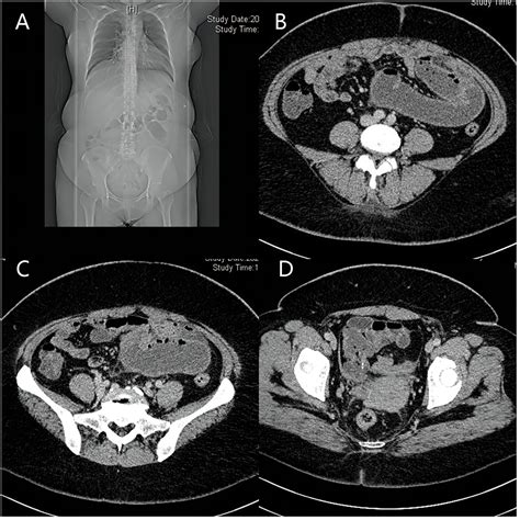 Frontiers Case Report Abdominal Cocoon With Jejuno Ileo Colonic Fistula