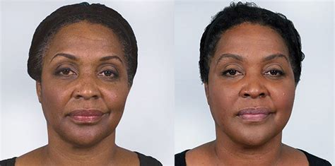 Sculptra Before and After Photos | Contour Dermatology