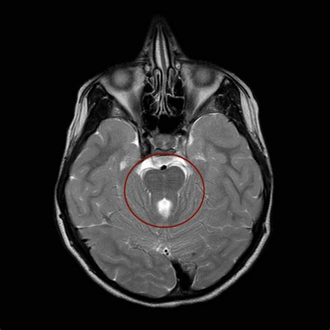 Axial T2 Weighted Magnetic Resonance Imaging Mri Scan Of The Brain