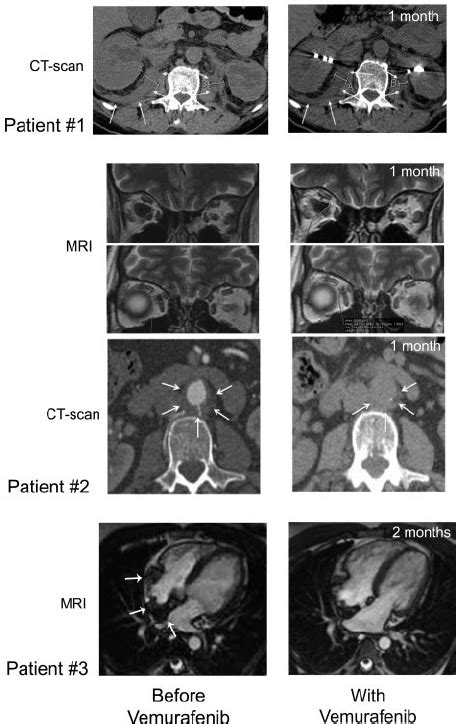 CT scan and MRI imaging assessment. Patient no. 1: Comparison of ...