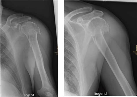 Proximal Humerus Fracture Presentation