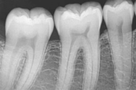 Tipos De Radiograf A Intraorales Y Extraorales Y Su Aplicaci N En Las