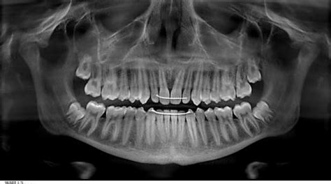 What Are Wisdom Teeth? | Library Park Dental