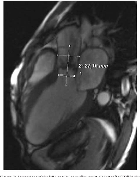 Figure 1 From Evidence Of Subannular And Left Ventricular Morphological Differences In Patients