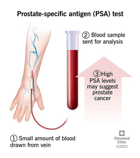 Prostate Specific Antigen PSA Test Purpose Results