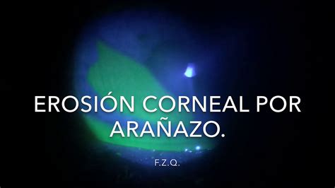 Erosi N Corneal Por Ara Azo Youtube