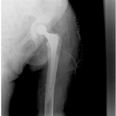 X Ray Of The Same Patient At One Year Follow Up Cemented Hip Download Scientific Diagram