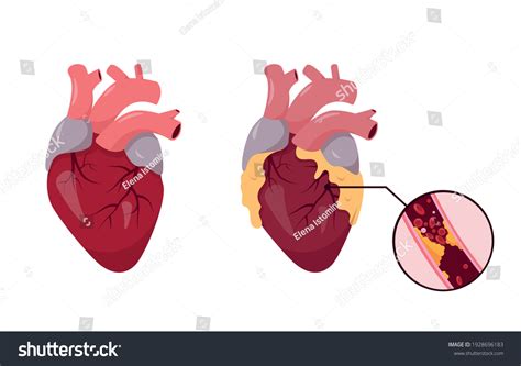 Heart Heath Over Royalty Free Licensable Stock Illustrations