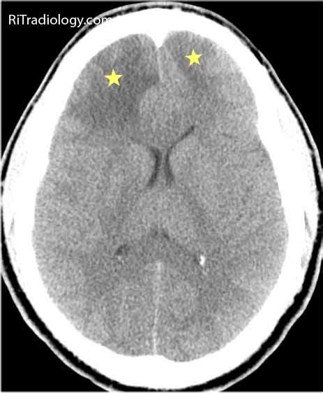 RiT Radiology Cerebral Venous Sinus Thrombosis CVST