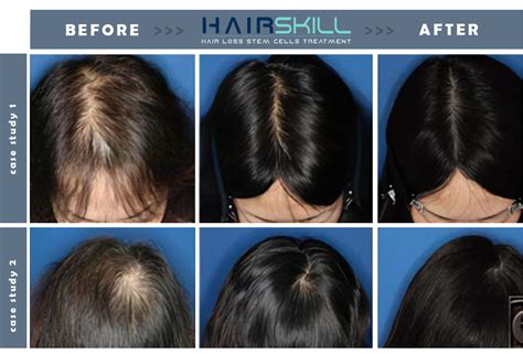 Stem Cell Treatment For Hair Loss Stem Cell Hair Growth