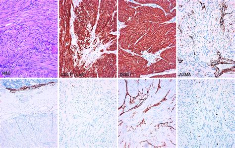 Tumor Was Constituted By Spindle Cells With Low Nuclear Pleomorphism