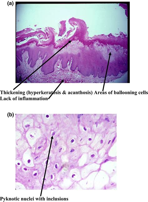 Leukoplakia Tongue Histology