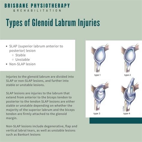 Shoulder Glenoid Labrum Injury What Is It Symptoms Treatment