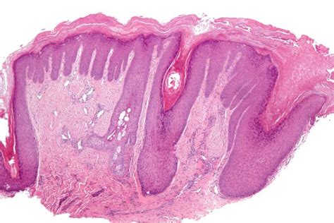 Lichen Simplex Chronicus Neurodermatitis — Causes And Symptoms