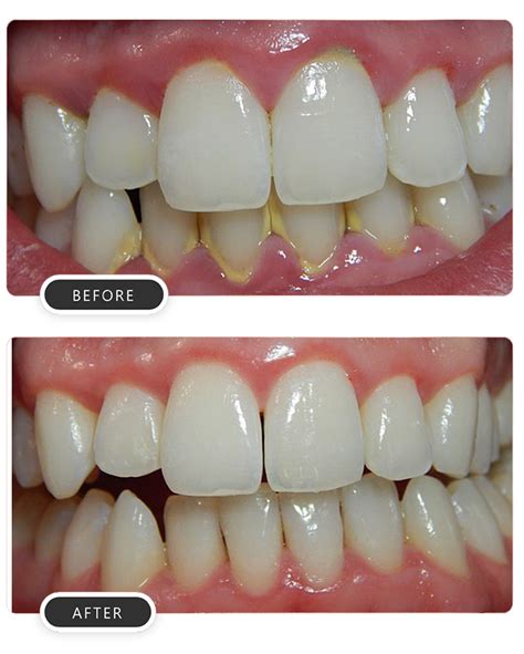 Cleaning And Polishing Scaling Smile Dental Hospitals