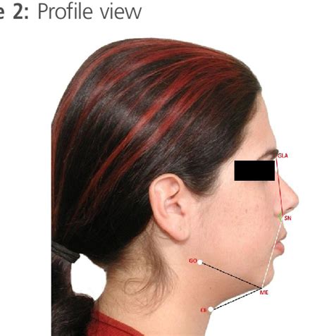 Figure 1 From Assessment Of The Craniofacial And Cervical Parameters