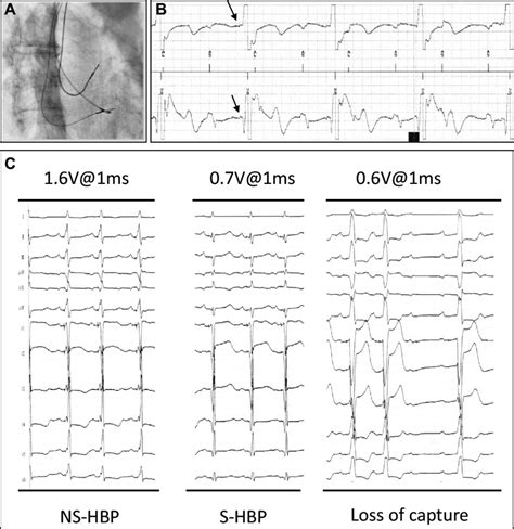 A Fluoroscopic Image Right Anterior Oblique Projection At The Time