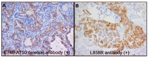 Immunohistochemical Detection Of A Egfr Exon E A Deletion