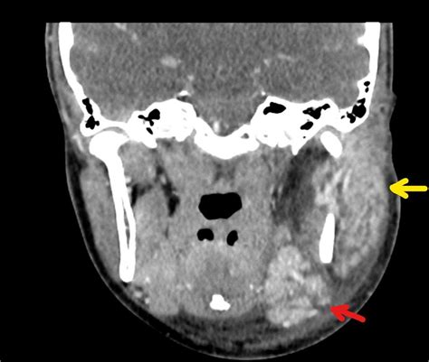 Mumps Presenting With Unilateral Synchronous Parotid And Submandibular