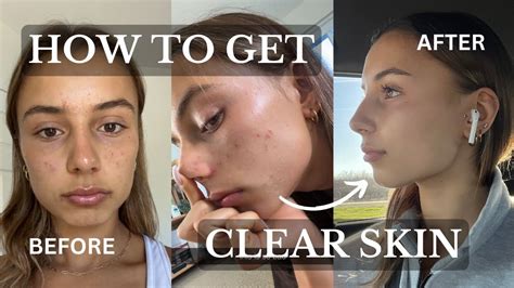 HOW TO GET CLEAR SKIN The Skincare Routine That Got Rid Of My Acne