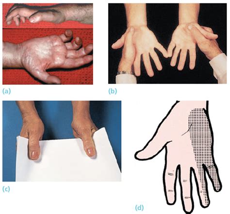 short cases: ulnar nerve examination