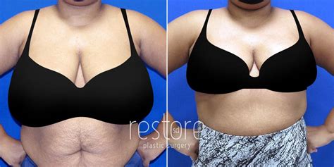 Before And After Plastic Surgery Breast Reduction