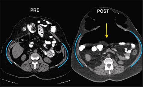 Frontiers Editorial Botox In Complex Abdominal Wall Surgery