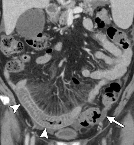 Pearls Pitfalls And Conditions That Mimic Mesenteric Ischemia At CT