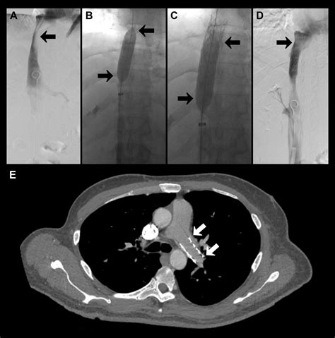 Inferior Vena Cava Reconstruction In Symptomatic Patients Using Palmaz