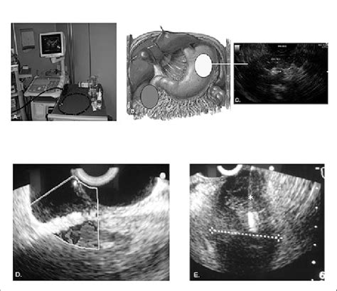 A Sectorial Endoscopic Ultrasound Eus B Anatomical Location Of Download Scientific Diagram