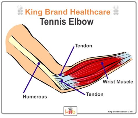 Elbow Ligaments And Tendons